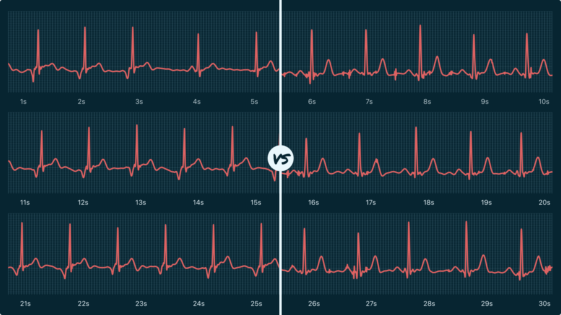 Junctional Rhythm Vs. First Degree AV Block on Your Watch ECG Qaly